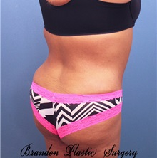 Tummy Tuck After Photo by Marvin Shienbaum, MD; Brandon, FL - Case 30460