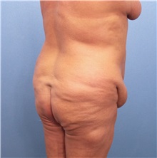 Tummy Tuck Before Photo by Marvin Shienbaum, MD; Brandon, FL - Case 30460