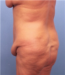 Tummy Tuck Before Photo by Marvin Shienbaum, MD; Brandon, FL - Case 30460