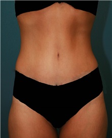 Tummy Tuck After Photo by Marvin Shienbaum, MD; Brandon, FL - Case 30461