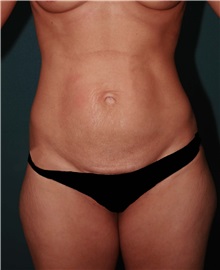 Tummy Tuck Before Photo by Marvin Shienbaum, MD; Brandon, FL - Case 30461