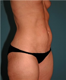 Tummy Tuck Before Photo by Marvin Shienbaum, MD; Brandon, FL - Case 30461