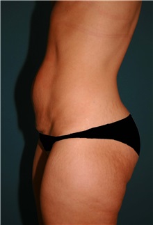 Tummy Tuck Before Photo by Marvin Shienbaum, MD; Brandon, FL - Case 30461