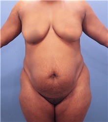 Tummy Tuck Before Photo by Marvin Shienbaum, MD; Brandon, FL - Case 30462