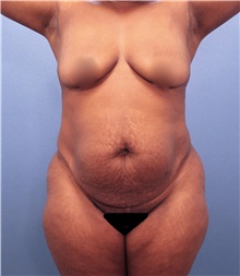 Tummy Tuck Before Photo by Marvin Shienbaum, MD; Brandon, FL - Case 30462