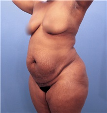 Tummy Tuck Before Photo by Marvin Shienbaum, MD; Brandon, FL - Case 30462