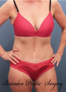 Tummy Tuck After Photo by Marvin Shienbaum, MD; Brandon, FL - Case 30463