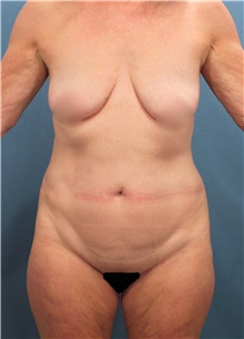 Tummy Tuck Before Photo by Marvin Shienbaum, MD; Brandon, FL - Case 30463