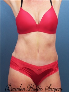 Tummy Tuck After Photo by Marvin Shienbaum, MD; Brandon, FL - Case 30463