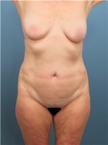 Tummy Tuck Before Photo by Marvin Shienbaum, MD; Brandon, FL - Case 30463