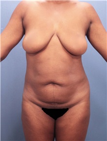 Tummy Tuck Before Photo by Marvin Shienbaum, MD; Brandon, FL - Case 30470