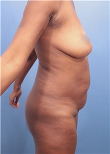 Tummy Tuck Before Photo by Marvin Shienbaum, MD; Brandon, FL - Case 30470