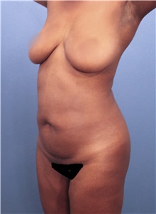 Tummy Tuck Before Photo by Marvin Shienbaum, MD; Brandon, FL - Case 30470