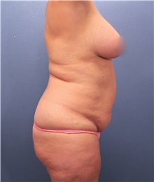 Tummy Tuck Before Photo by Marvin Shienbaum, MD; Brandon, FL - Case 30471