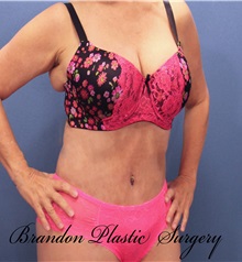 Tummy Tuck After Photo by Marvin Shienbaum, MD; Brandon, FL - Case 30471