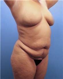 Tummy Tuck Before Photo by Marvin Shienbaum, MD; Brandon, FL - Case 30472