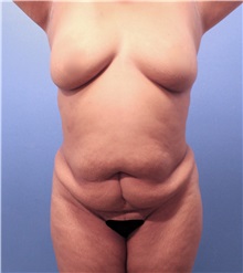 Tummy Tuck Before Photo by Marvin Shienbaum, MD; Brandon, FL - Case 30472