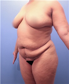 Tummy Tuck Before Photo by Marvin Shienbaum, MD; Brandon, FL - Case 30472