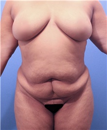 Tummy Tuck Before Photo by Marvin Shienbaum, MD; Brandon, FL - Case 30472