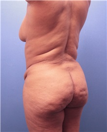 Tummy Tuck Before Photo by Marvin Shienbaum, MD; Brandon, FL - Case 30472