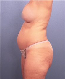 Tummy Tuck Before Photo by Marvin Shienbaum, MD; Brandon, FL - Case 30473