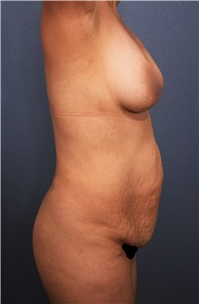 Tummy Tuck Before Photo by Marvin Shienbaum, MD; Brandon, FL - Case 30474