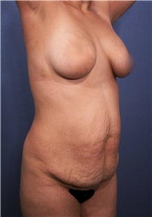 Tummy Tuck Before Photo by Marvin Shienbaum, MD; Brandon, FL - Case 30474