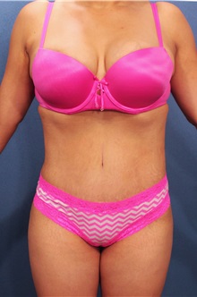 Tummy Tuck After Photo by Marvin Shienbaum, MD; Brandon, FL - Case 30474