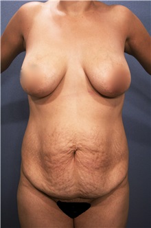 Tummy Tuck Before Photo by Marvin Shienbaum, MD; Brandon, FL - Case 30474