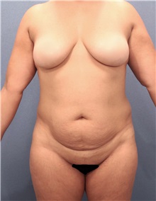 Tummy Tuck Before Photo by Marvin Shienbaum, MD; Brandon, FL - Case 30475