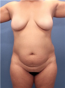 Tummy Tuck Before Photo by Marvin Shienbaum, MD; Brandon, FL - Case 30475