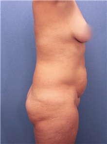 Tummy Tuck Before Photo by Marvin Shienbaum, MD; Brandon, FL - Case 30475