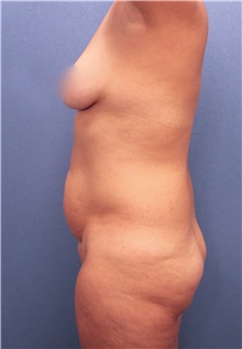 Tummy Tuck Before Photo by Marvin Shienbaum, MD; Brandon, FL - Case 30475