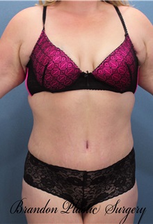 Tummy Tuck After Photo by Marvin Shienbaum, MD; Brandon, FL - Case 30476