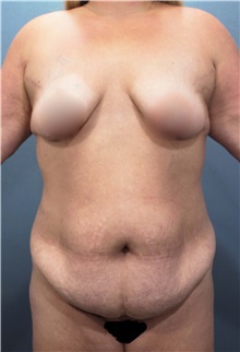 Tummy Tuck Before Photo by Marvin Shienbaum, MD; Brandon, FL - Case 30476