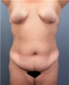 Tummy Tuck Before Photo by Marvin Shienbaum, MD; Brandon, FL - Case 30476