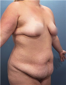 Tummy Tuck Before Photo by Marvin Shienbaum, MD; Brandon, FL - Case 30476