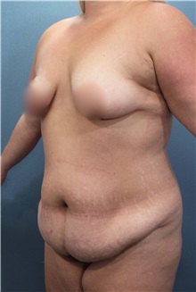 Tummy Tuck Before Photo by Marvin Shienbaum, MD; Brandon, FL - Case 30476