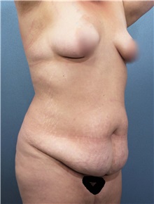 Tummy Tuck Before Photo by Marvin Shienbaum, MD; Brandon, FL - Case 30476