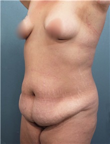 Tummy Tuck Before Photo by Marvin Shienbaum, MD; Brandon, FL - Case 30476