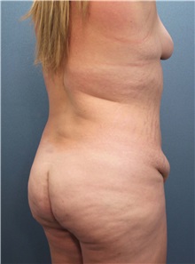 Tummy Tuck Before Photo by Marvin Shienbaum, MD; Brandon, FL - Case 30476