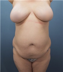 Tummy Tuck Before Photo by Marvin Shienbaum, MD; Brandon, FL - Case 30477