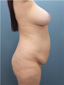 Tummy Tuck Before Photo by Marvin Shienbaum, MD; Brandon, FL - Case 30477