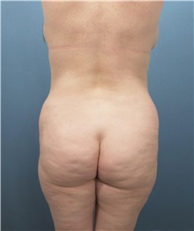 Tummy Tuck Before Photo by Marvin Shienbaum, MD; Brandon, FL - Case 30477