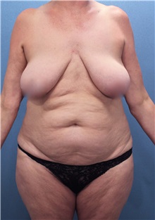 Tummy Tuck Before Photo by Marvin Shienbaum, MD; Brandon, FL - Case 30478