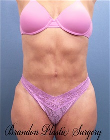 Tummy Tuck After Photo by Marvin Shienbaum, MD; Brandon, FL - Case 30478