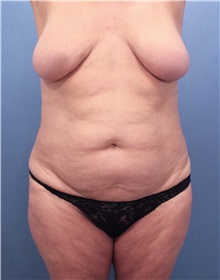 Tummy Tuck Before Photo by Marvin Shienbaum, MD; Brandon, FL - Case 30478