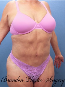 Tummy Tuck After Photo by Marvin Shienbaum, MD; Brandon, FL - Case 30478