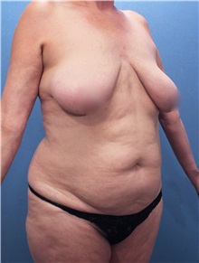 Tummy Tuck Before Photo by Marvin Shienbaum, MD; Brandon, FL - Case 30478