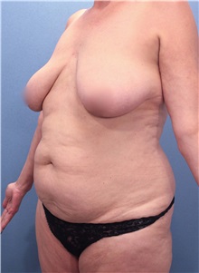 Tummy Tuck Before Photo by Marvin Shienbaum, MD; Brandon, FL - Case 30478